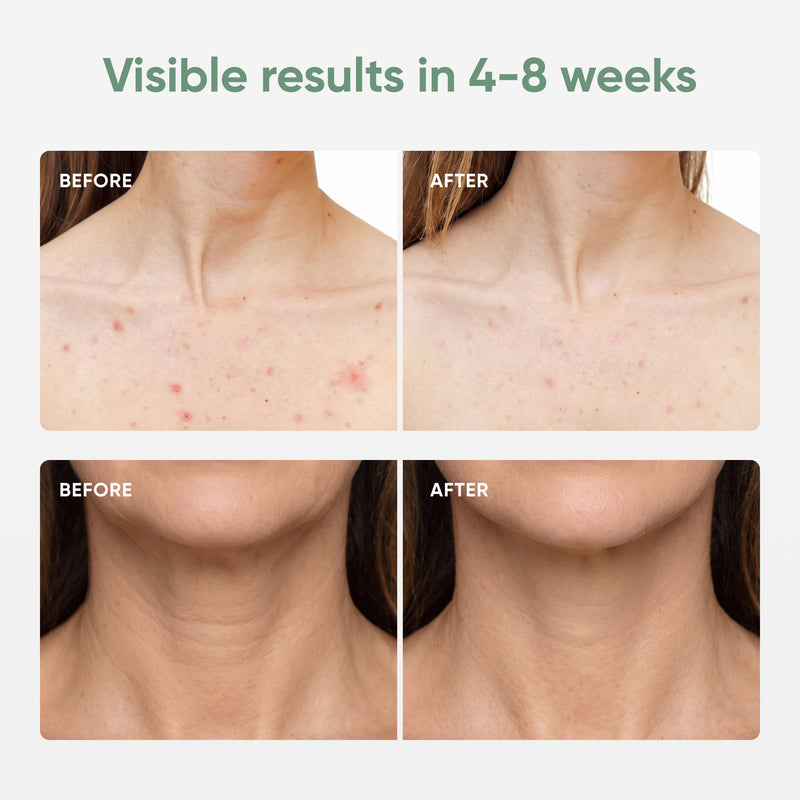Nanoleaf Light Therapy Neck & Décolletage Mask